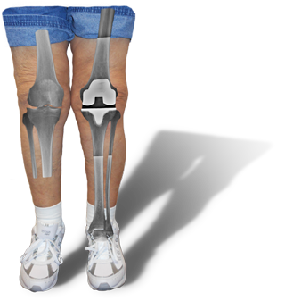 image of legs with knee arthritis on the left and knee replacement on the right