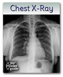 Chest xray for pre-op exam