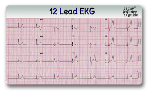 EKG for pre-op exam