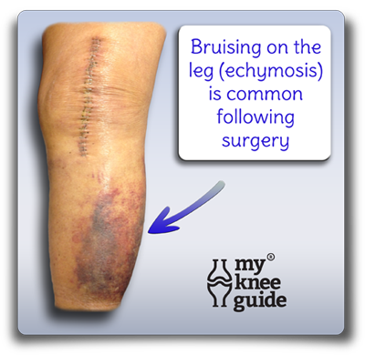 Bruising of skin after knee replacement