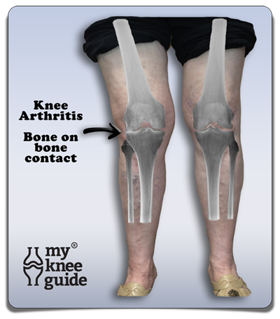 Knee Arthritis