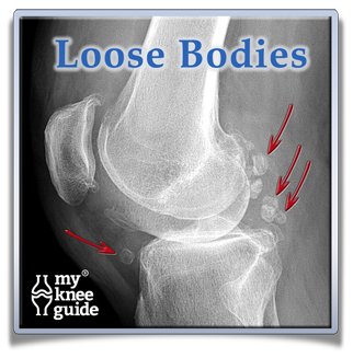 Knee arthritis with loose bodies