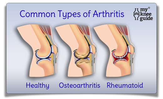 Knee Arthritis osteoarthritis and rheumatoid
