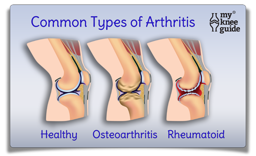 rheumatoid arthritis knee symptoms