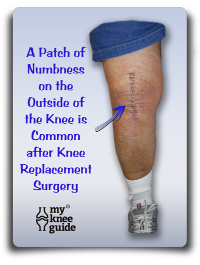 Knee Numbness A Common Post Operative Finding