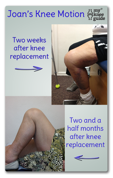 How to Elevate the Leg After Knee Replacement 