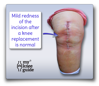 red wound after knee replacement