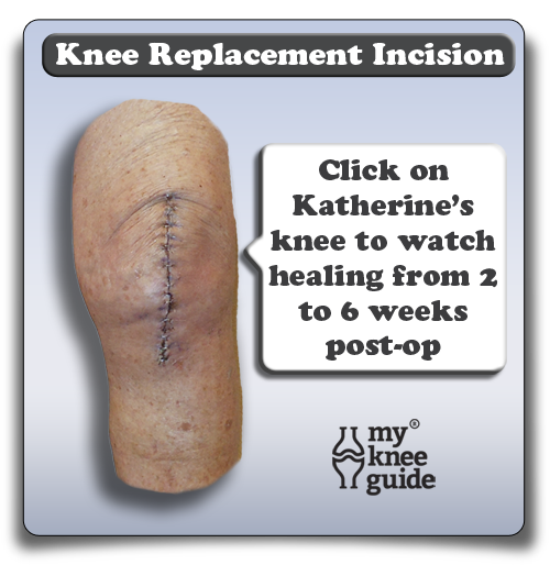 partial knee replacement scar