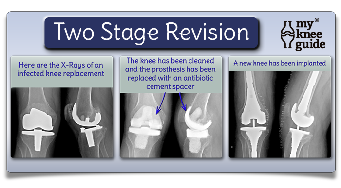 two stage revision total knee arthroplasty following infection