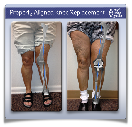 knee replacement knock knees correction propublica patients complications deformity surgery alignment properly leg arthritis aligned pain genu misleads surgical bow