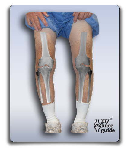 Bilateral knee arthritis