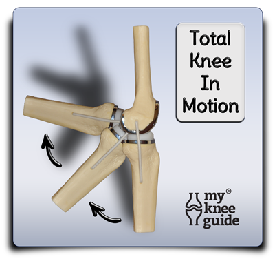 Total Knee components in Motion flexion and extension