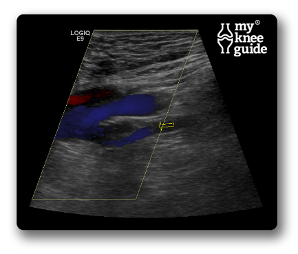 blood clot in leg ultrasound