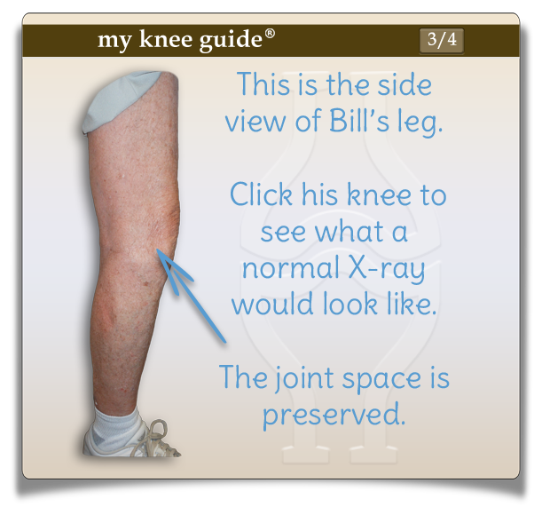 Bill's knee side view