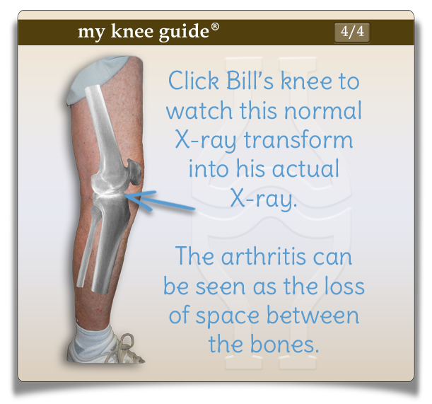 Bill's knee xray shows loss of space between the bones