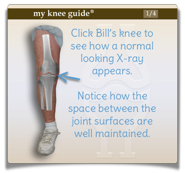 Bill's knee with xray of knee without arthritis