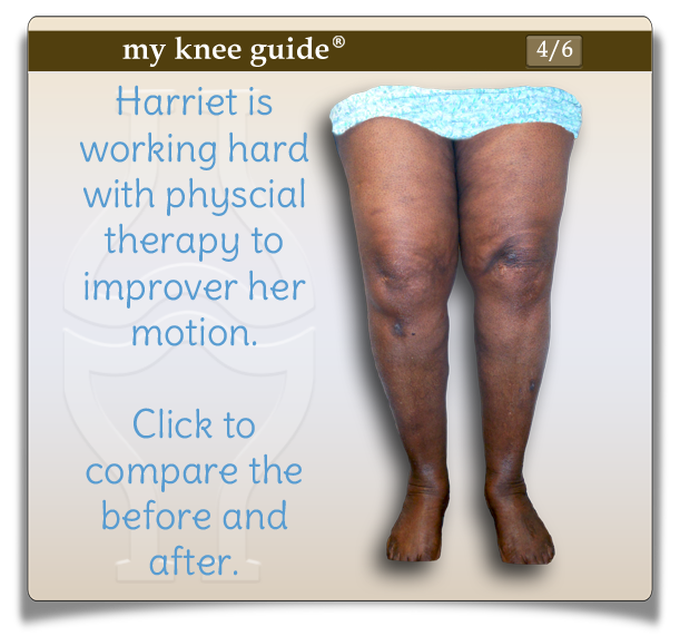Harriet's knees before knee replacement surgery. She is working hard with physical therapy to improve her motion. - My Knee Guide X-ray Vision Center