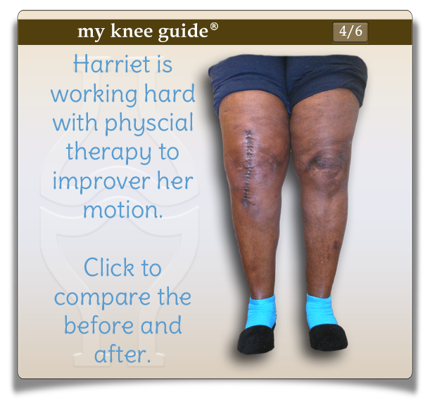 Click on Harriet's knee to compare the pictures of before and after knee replacement. - My Knee Guide X-ray Vision Center