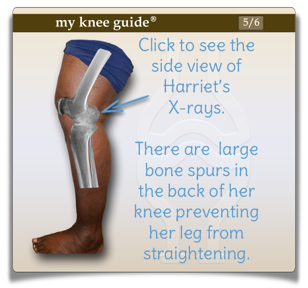 Side view of Harriet's leg after knee replacement surgery. There are large bone spurs in the back of her knee preventing her leg from straightening. - My Knee Guide X-ray Vision Center