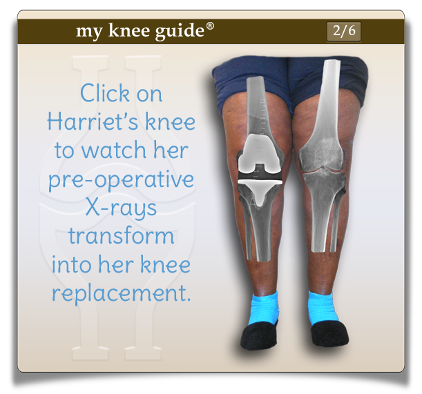 Harriet's knees showing her postoperative xrays transform next to her xrays of severe knee arthritis. - My Knee Guide X-ray Vision Center