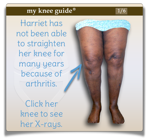 Harriet has not been able to straighten her knee for many years. - My Knee Guide X-ray Vision Center