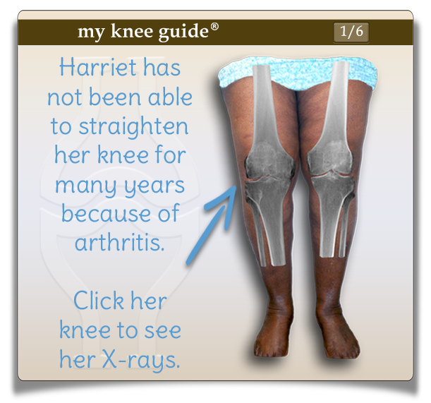 Harriet's knee with x-rays showing her arthritis. - My Knee Guide X-ray Vision Center