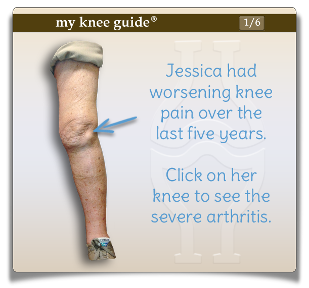 Jessica's leg before x-ray is applied. Click to see the severe arthritis.