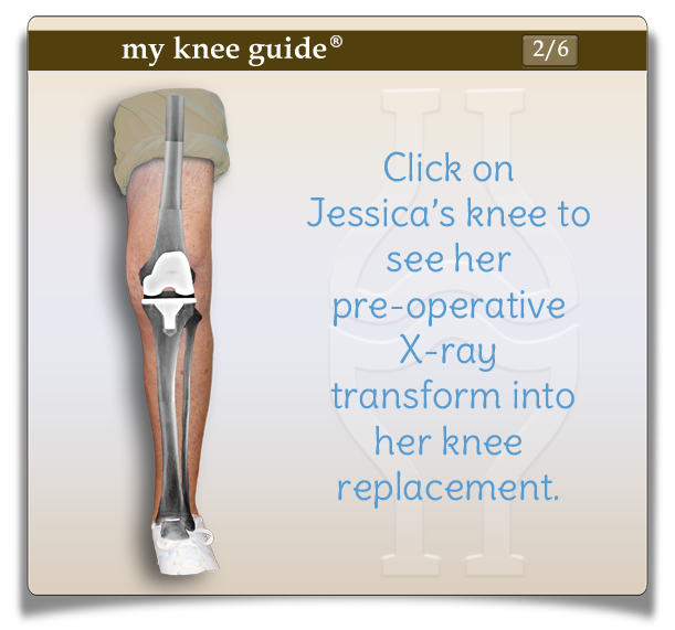 Jessica's leg showing knee replacement components and correction of knee deformity