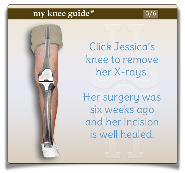 Jessica's leg showing knee replacement components