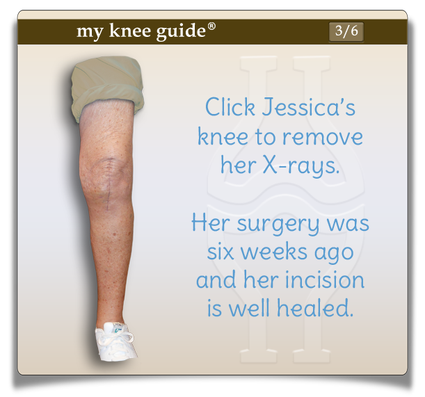Jessica's leg six weeks post-op from knee replacement surgery