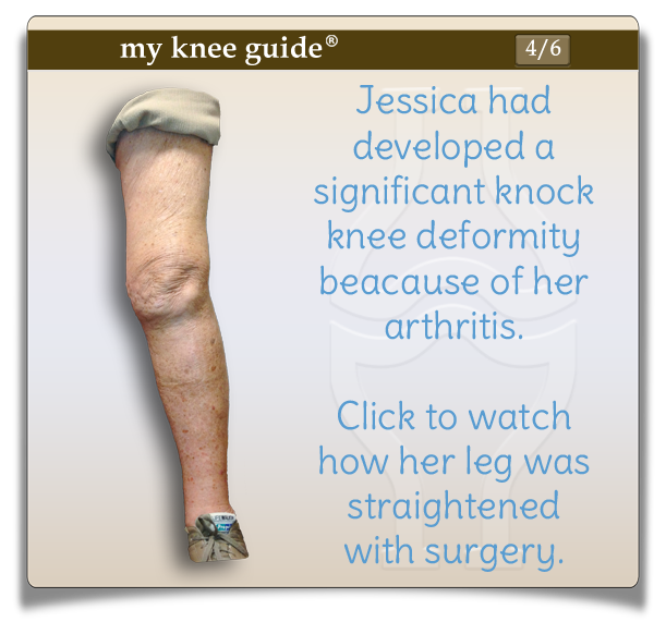 Jessica's knee before surgery with valgus deformity