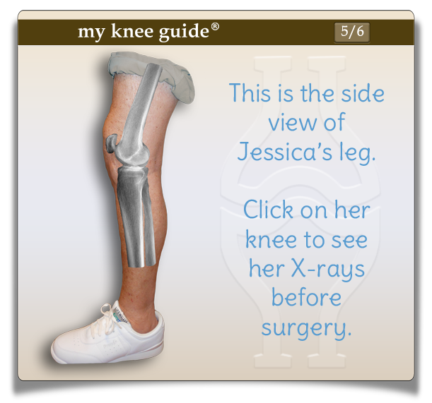 Jessica's leg from the side view with pre-operative x-rays seen.