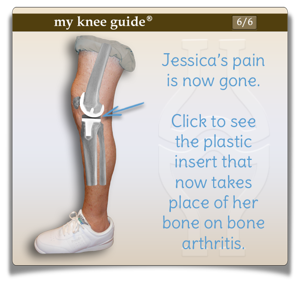 Jessica's knee after surgery with knee replacement components seen on x-ray
